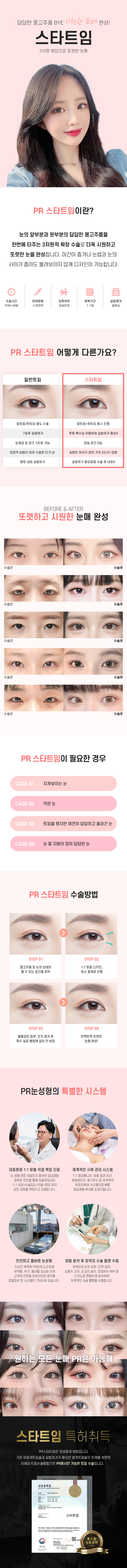 트임수술