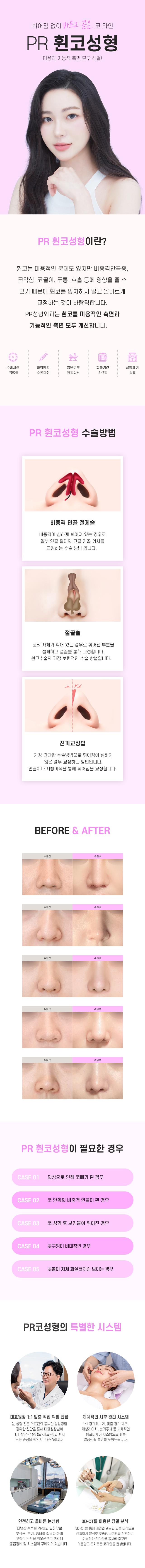 휜코교정