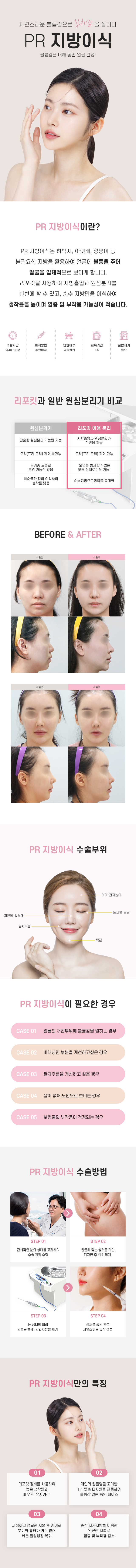 소프트안면윤곽